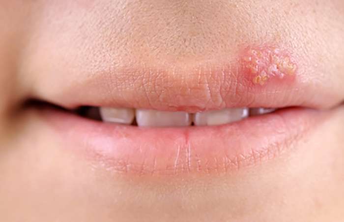 Can Lip Fillers Trigger Cold Sores?