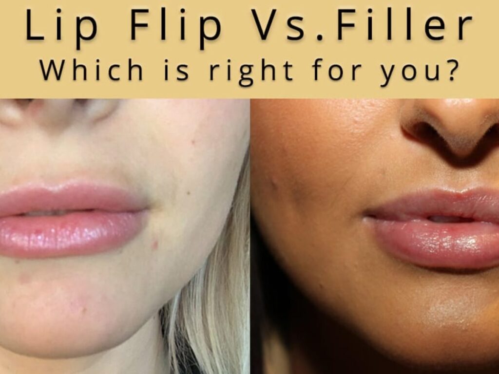 All About The Lip Flip | Harbour Medispa Wilston ~ Cosmetic Injections