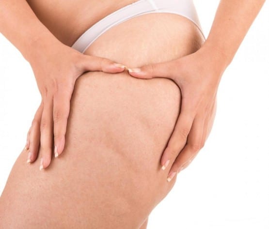 Fat and Cellulite Reduction Injections With Lipodissolve | Harbour Medispa Hamilton
